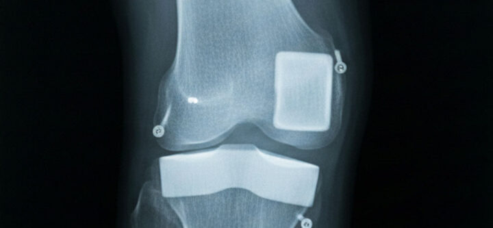 عملية-تغيير-مفصل-الركبة