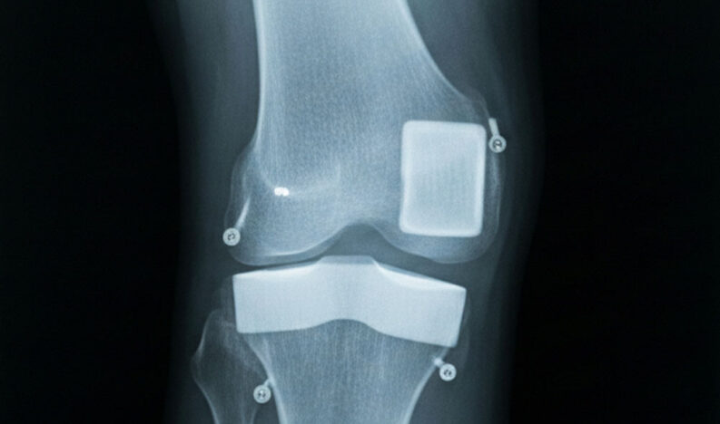 عملية-تغيير-مفصل-الركبة