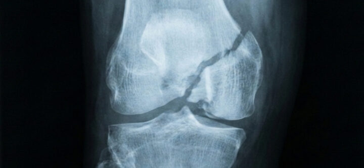 كسور-مفصل-الركبة