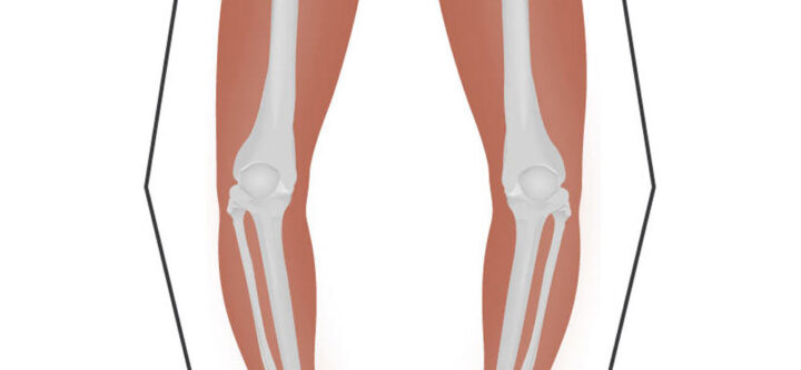علاج-التقوس--والتشوة