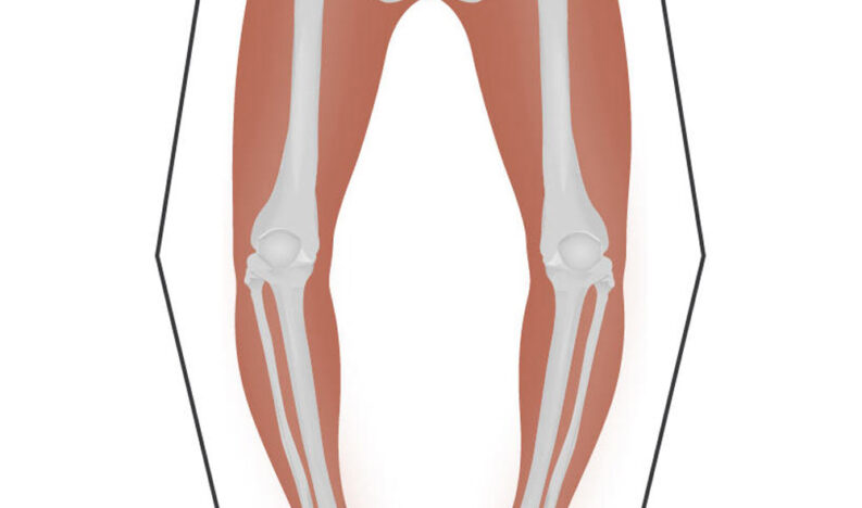 علاج-التقوس--والتشوة